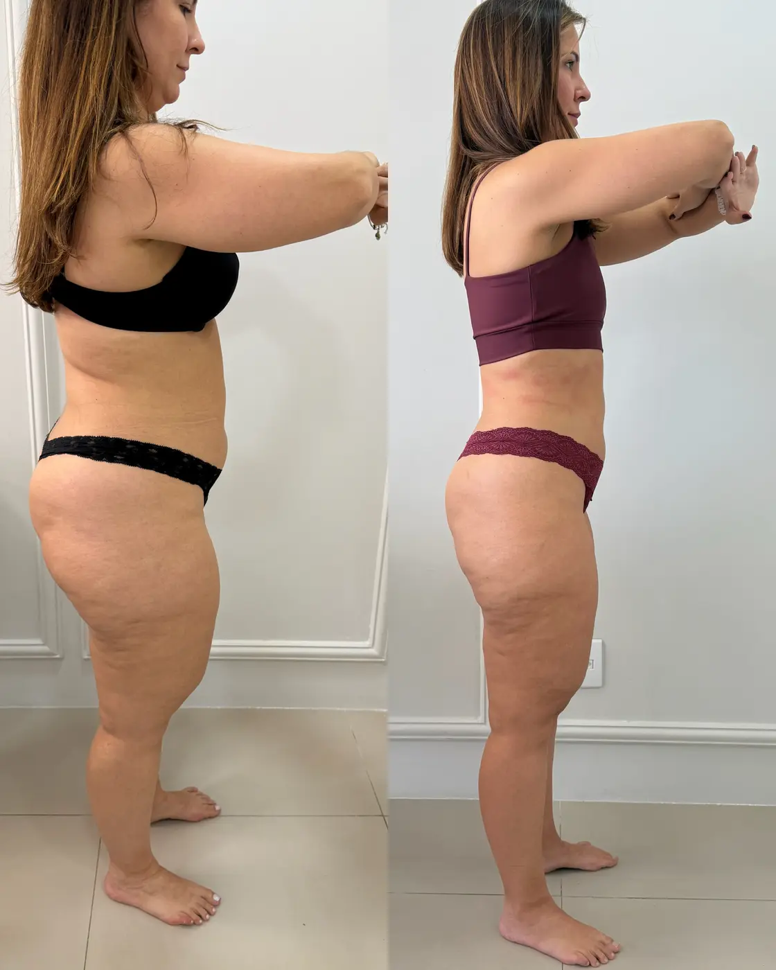 Tratamento para gordura localizada — resultado